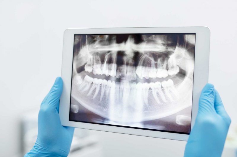 Dental X-Rays in Thousand Oaks
